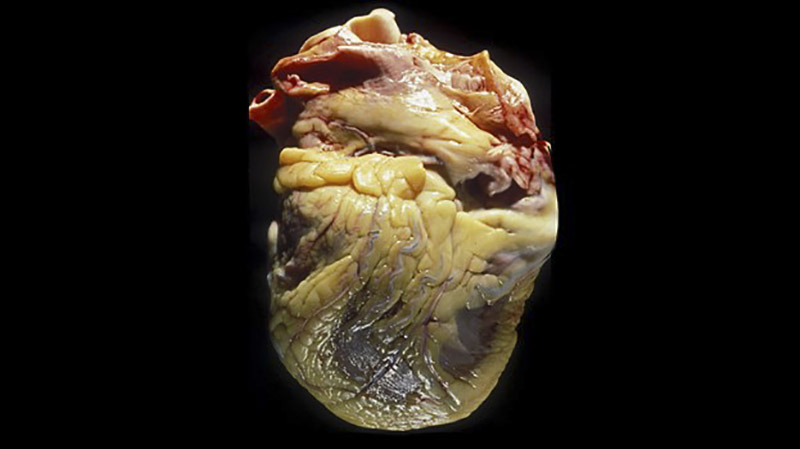 Mỡ thừa tích tụ ngoài màng tim sẽ gây ra nhiều bệnh về tim mạch